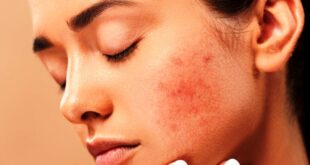 Tips Menghilangkan Bekas Jerawat dengan Menggunakan Bahan Alami