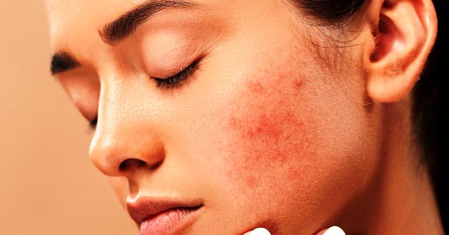 Tips Menghilangkan Bekas Jerawat dengan Menggunakan Bahan Alami